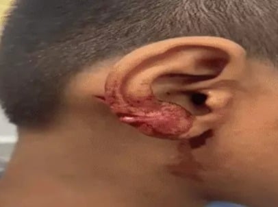 Student injured at Dhanas school, father claims he was attacked by classmates