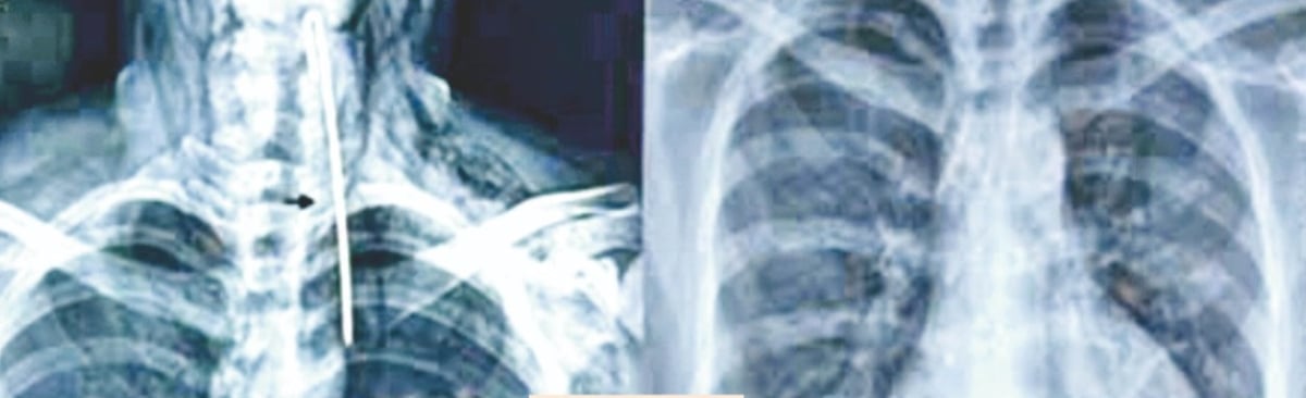 Turban pin swallowed by youth reaches heart muscle, PGI doctors save life with rare surgery